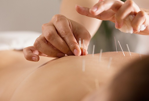 Acupuncture